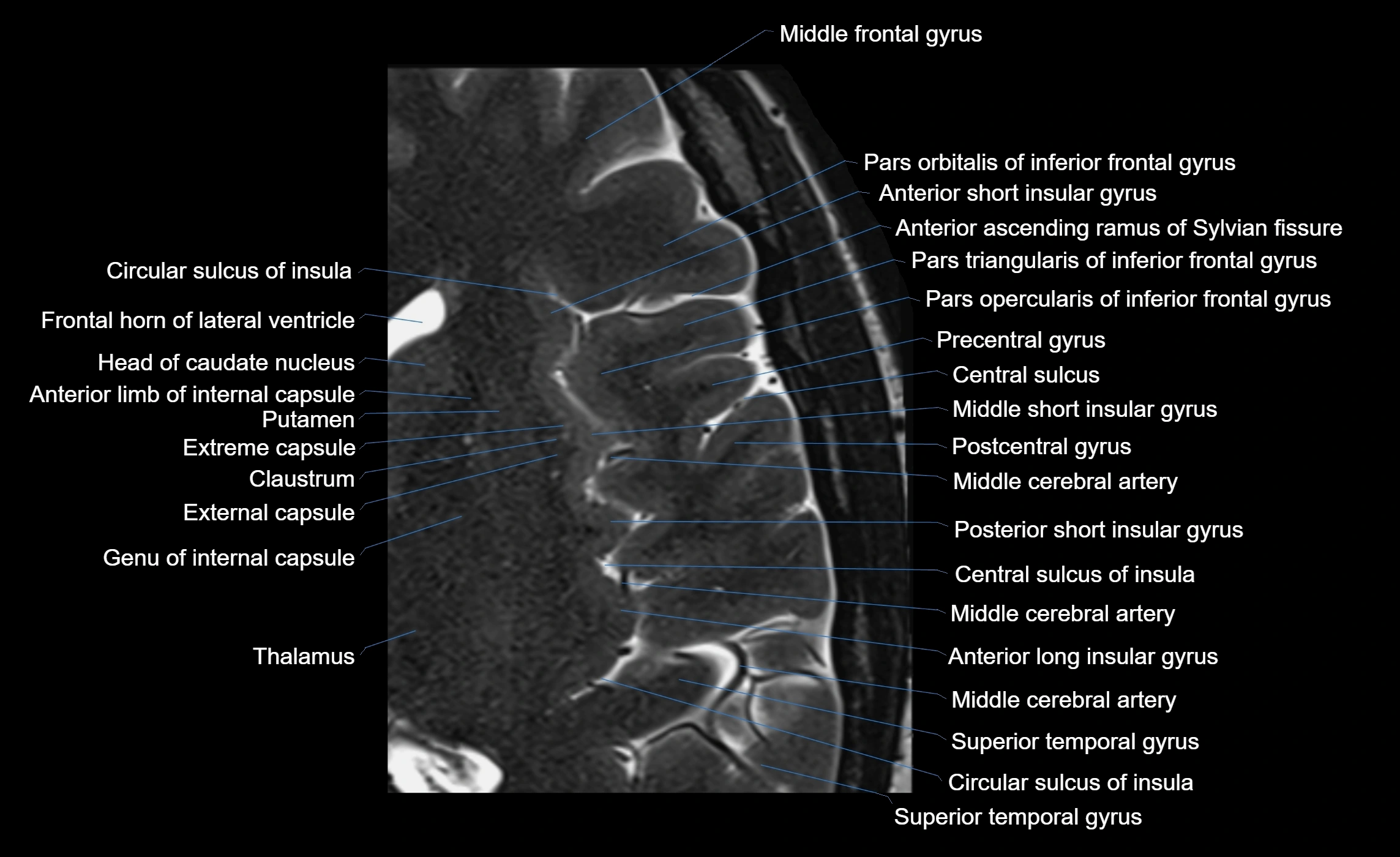 Brain insula axial  anatomy 3T MRI image-img-00001-00014.webp